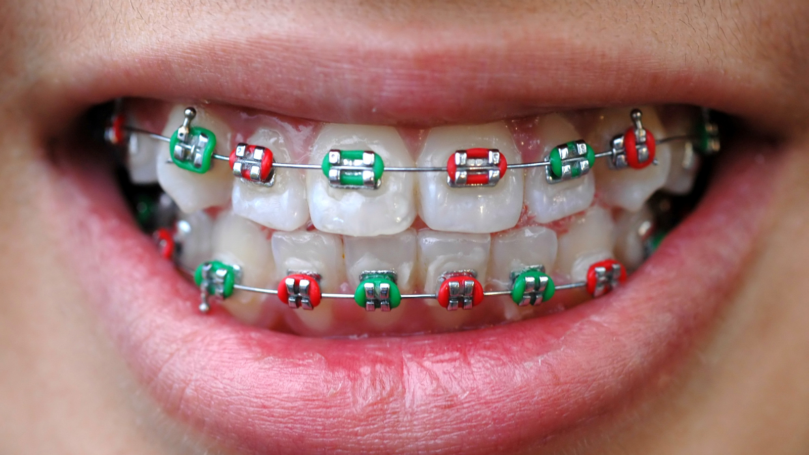 george orthodontics braces color wheel