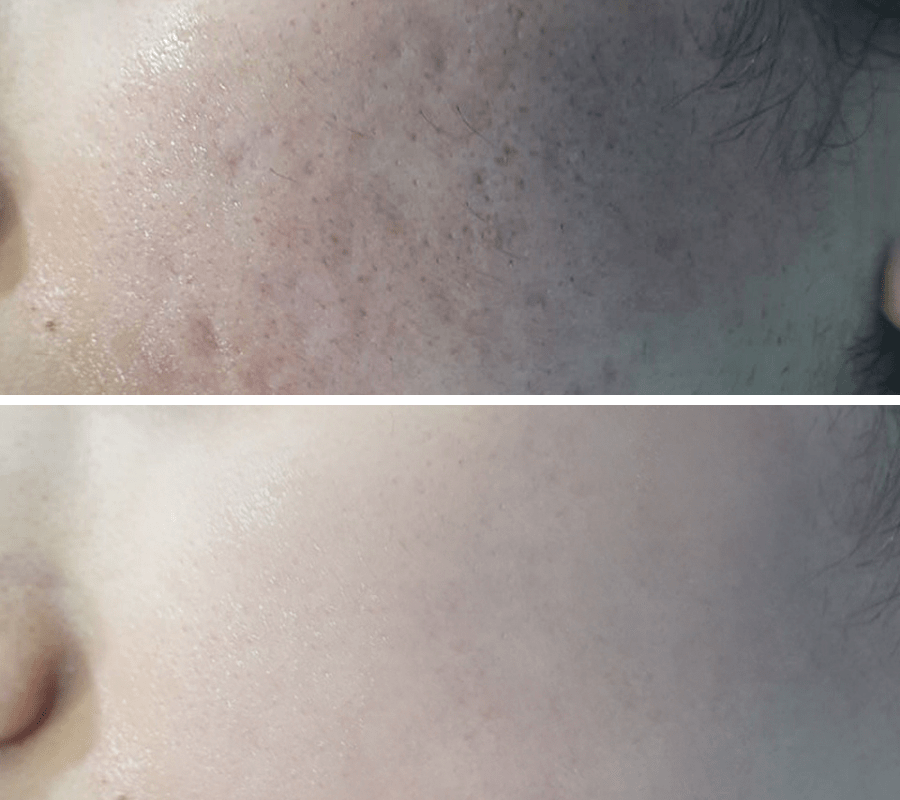Acne Scars Before and After