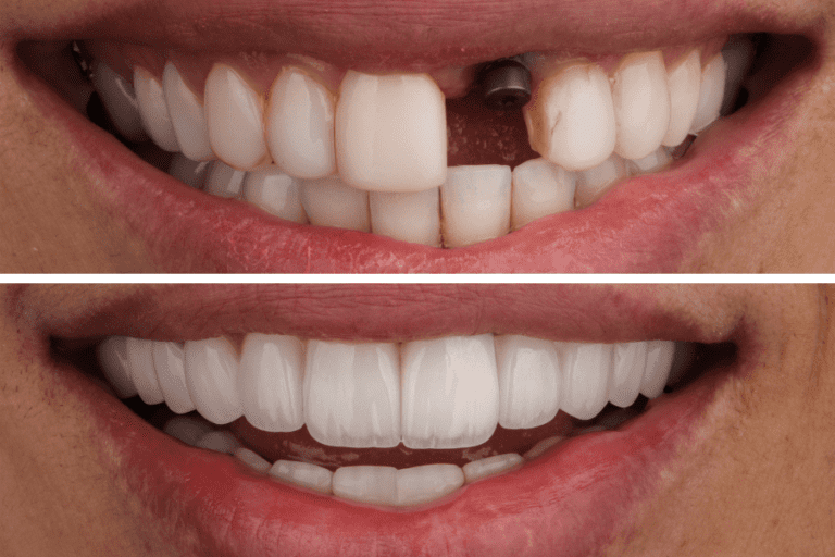 Dental Implants Dentist in Dubai Queens Medical Center