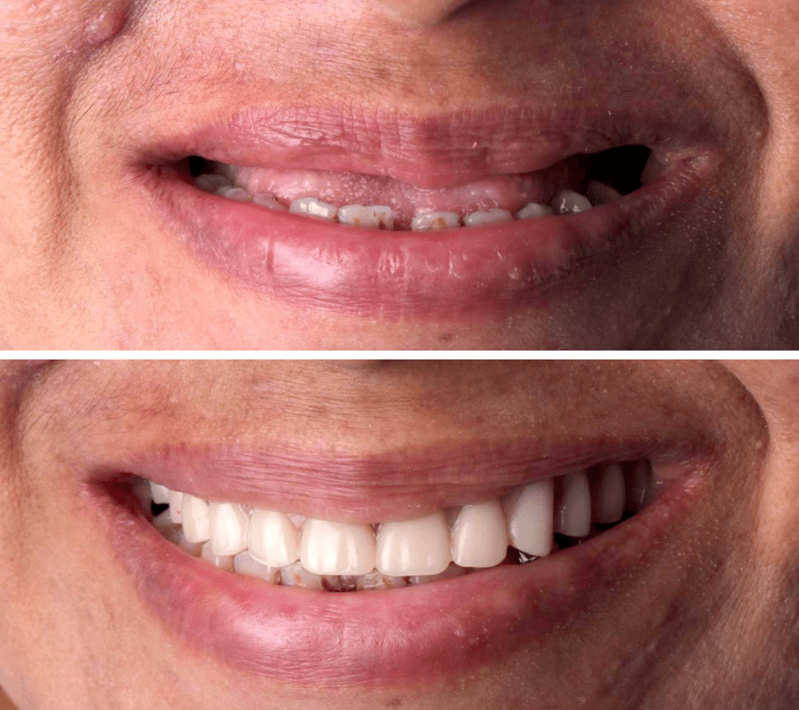 Dentures Before and After