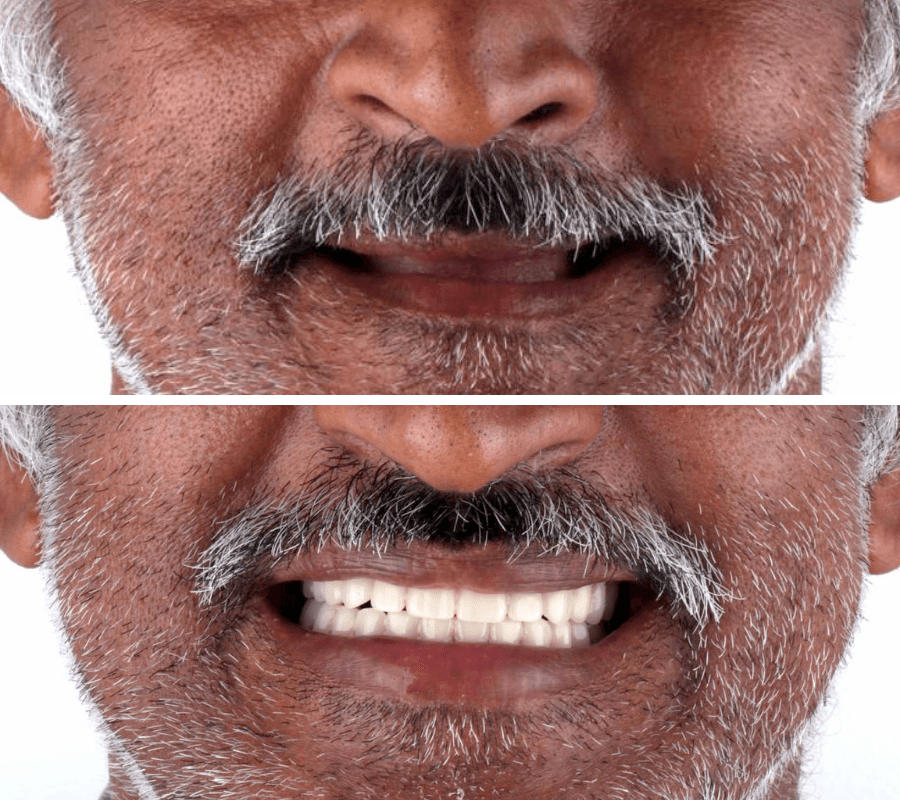 Dentures Before and After