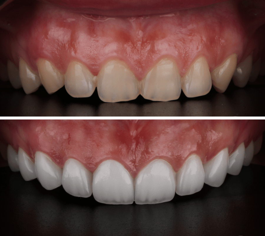 Hollywood Smile - Before and After