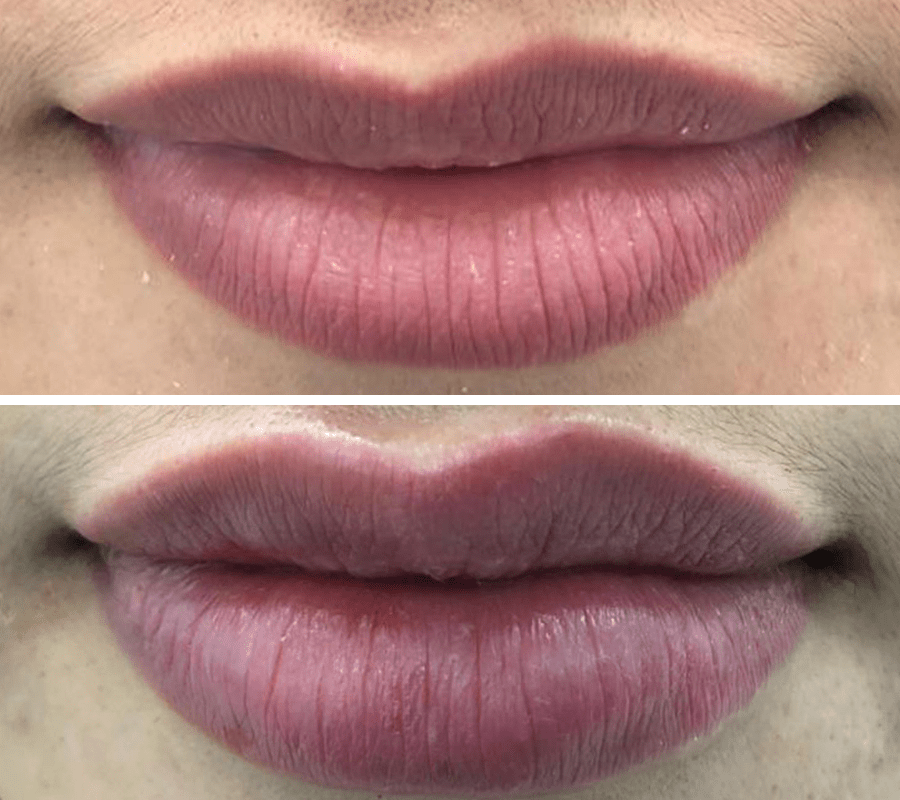Lip Fillers Before and After