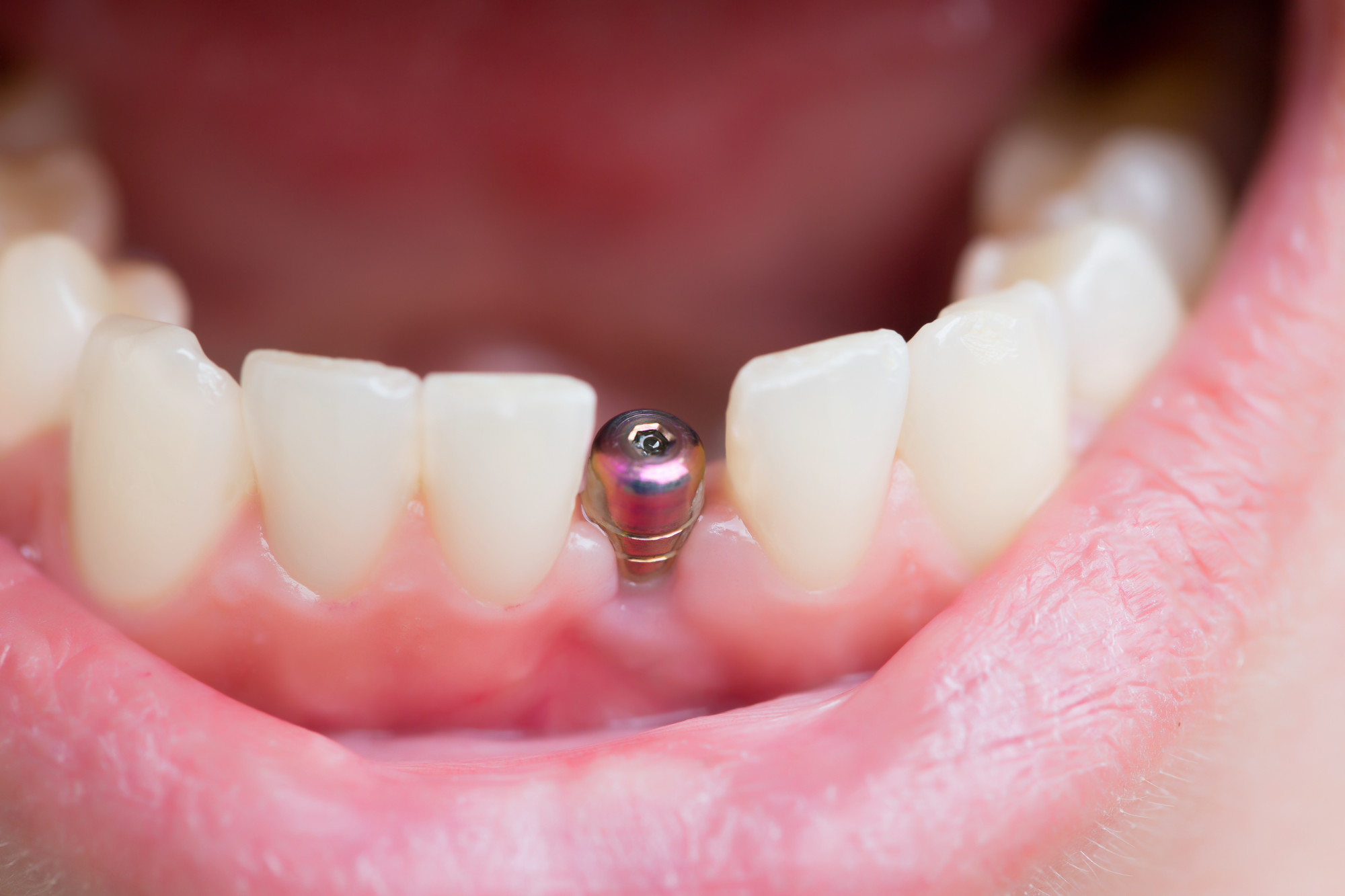 single-tooth-implant